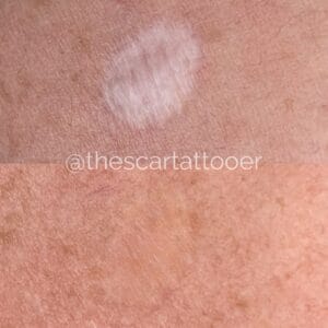 scar camouflage tattoo before and aftercare