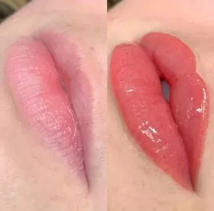 Optimize Your Lip Enhancement: Lip Blush Before or After Fillers?