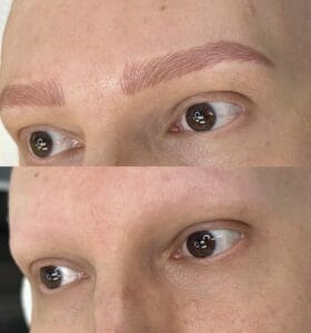 Cosmetic tattoo for hair loss due to cancer, alopecia and trichotillomania