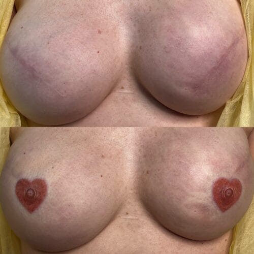 Areola Restoration Training at DAELA Academy