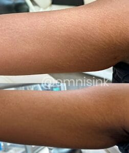 What is a stretch mark camouflage tattoo?