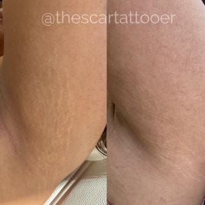 What is Stretch Mark Serum Treatment?