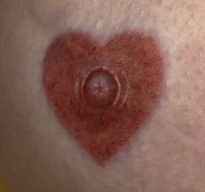 The Art of Areola Restoration Tattoo: A Canvas of Creativity and Confidence