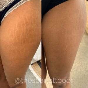 Top 3 Stretch Mark Treatments