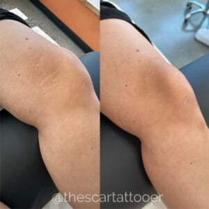 Top 3 Stretch Mark Treatments