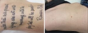 laser tattoo removal