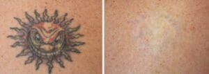 Laser tattoo Removal 9 Treatments