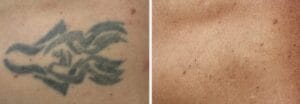 laser tattoo removal