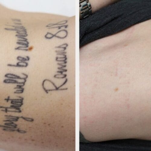 Top 10 Questions About Tattoo Removal