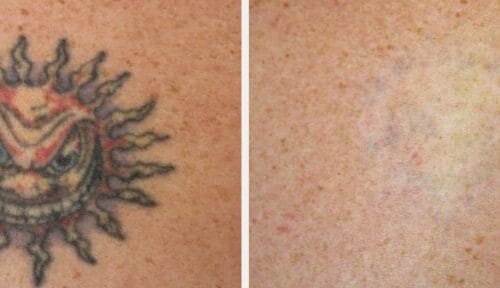 tattoo removal