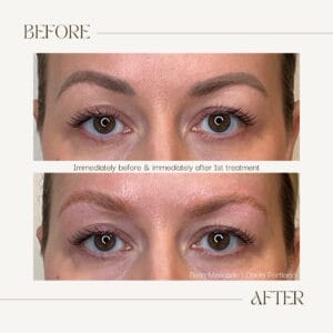 Permanent Makeup Tattoo Removal at DAELA Portland