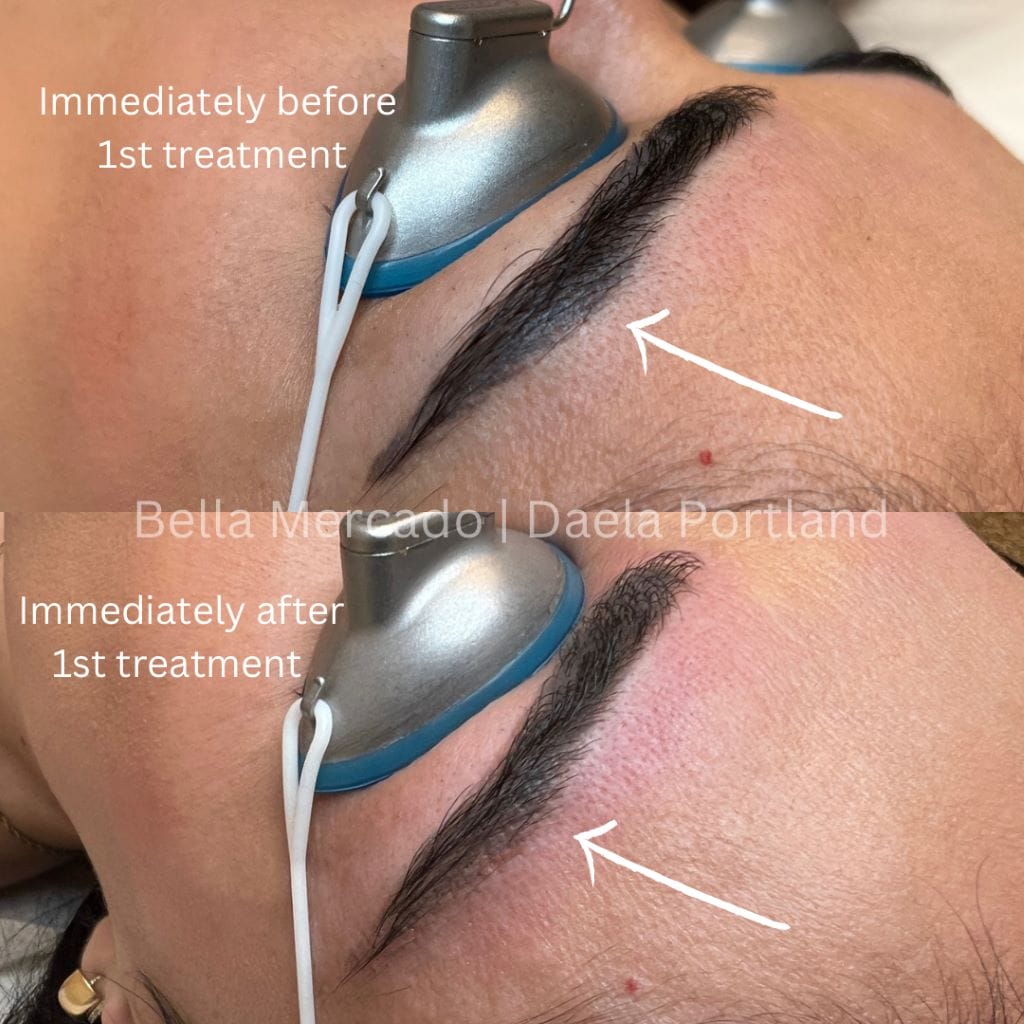 Top 10 Questions About Permanent Makeup Removal