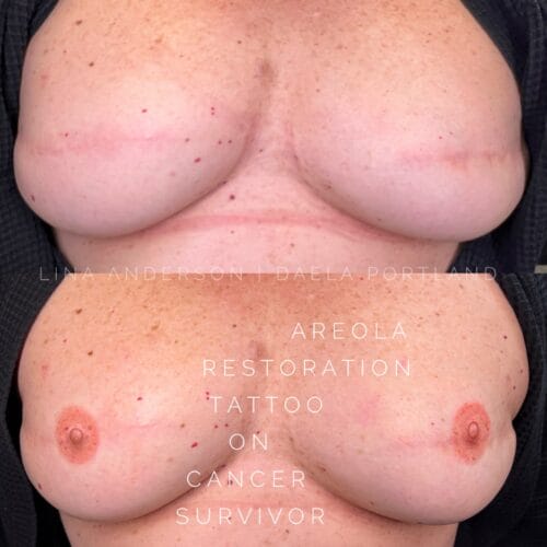 3D Areola Restoration at DAELA Cosmetic Tattoo