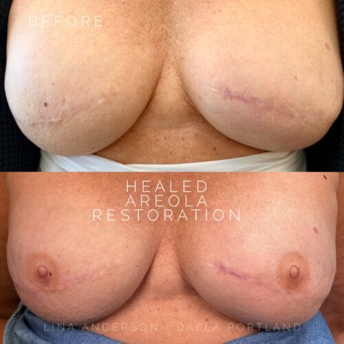3D Areola Restoration at DAELA Cosmetic Tattoo