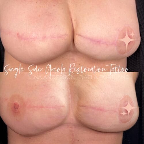 3D Areola Restoration at DAELA Cosmetic Tattoo