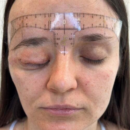 Restorative Cosmetic Tattoo: Enhancing Symmetry with Nano Brows