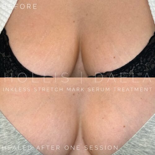 Benefits of Inkless Scar and Stretch Mark Serum Treatments