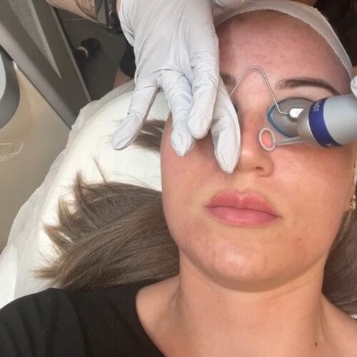 Laser Skin Treatments at DAELA Cosmetic Tattoo