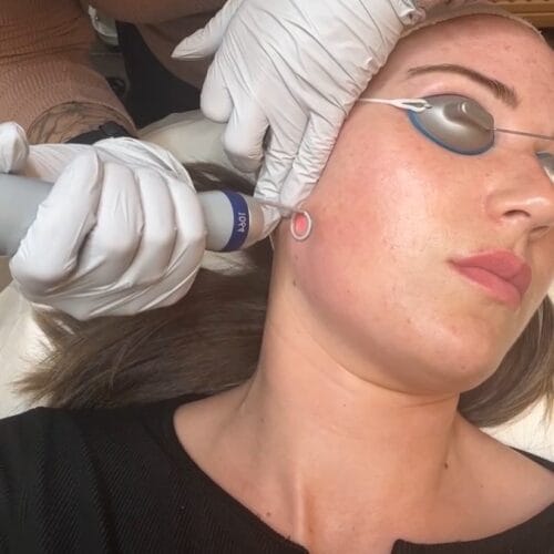 The Top 10 Questions About Non-Ablative Laser Skin Treatments—Answered!