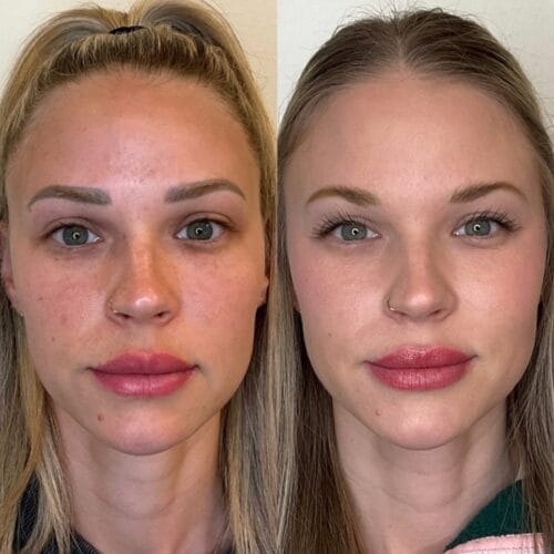 The Top 10 Questions About Non-Ablative Laser Skin Treatments—Answered!