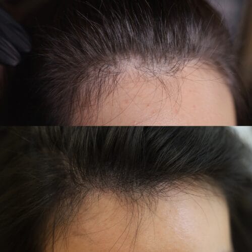 Scalp Micropigmentation for women's density