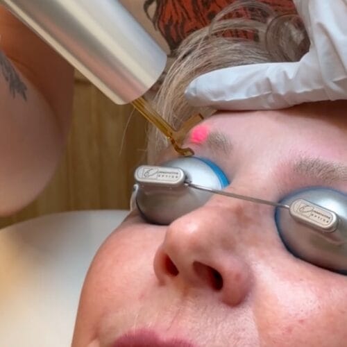 Why Microneedling Between Brow Tattoo Removal Sessions Works