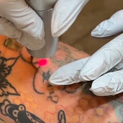 Understanding Microneedling and Laser Tattoo Removal