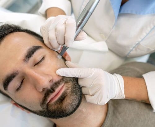 Microneedling at DAELA Cosmetic Tattoo