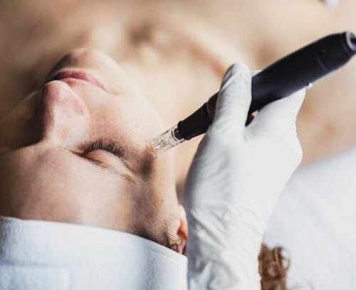 Microneedling at DAELA Cosmetic tattoo