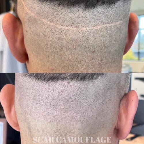 SMP for Hair Transplant scars at DAELA