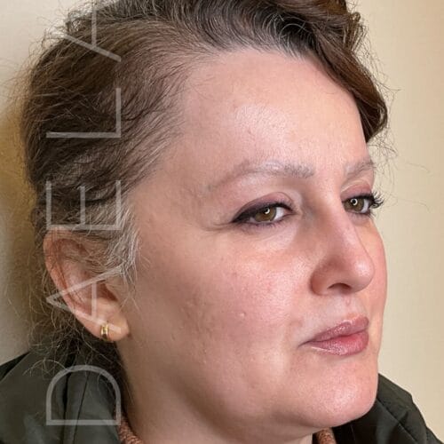 Microneedling & Brow Regrowth