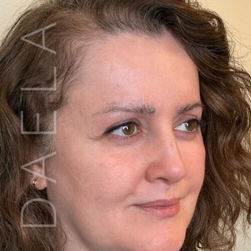 microneedling for brow hair regrowth after