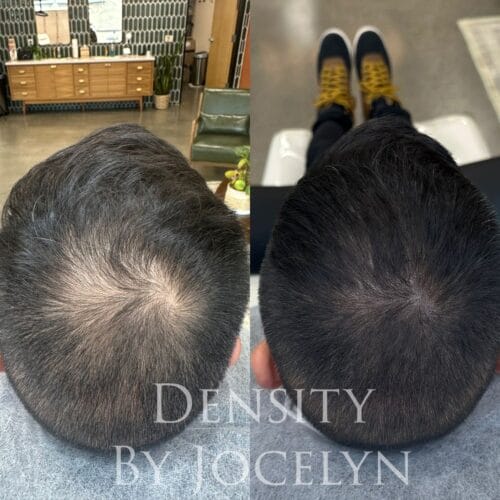 Comprehensive Guide to Scalp Micropigmentation: SMP for Hair Density at DAELA