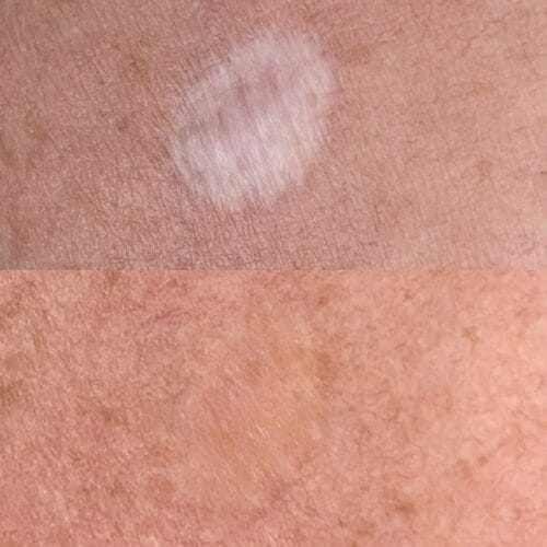 Scar Camouflage Tattoo at DAELA