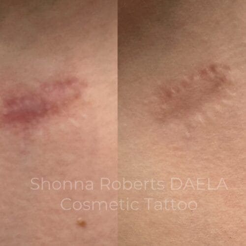 Scar Serum Treatments at DAELA