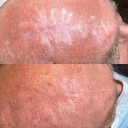 How Scar Camouflage Restores Confidence After Skin Cancer Scarring