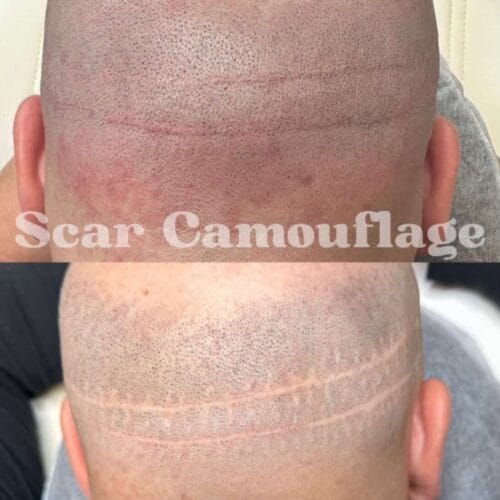 How SMP Conceals Hair Transplant Scars and Restores Confidence