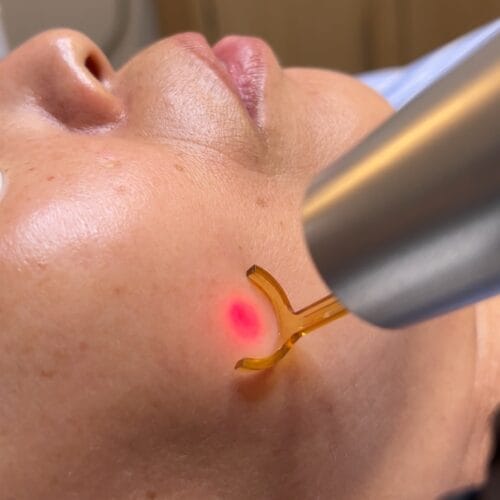 Safe Melanin Rich Skin Laser Treatments