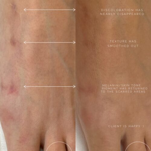 Scar Camouflage in Scottsdale at DAELA