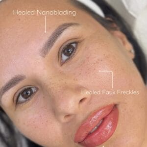 nanoblading and Freckles DAELA
