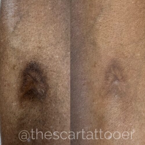Scar camouflage tattoo by Shonna at DAELA Cosmetic Tattoo