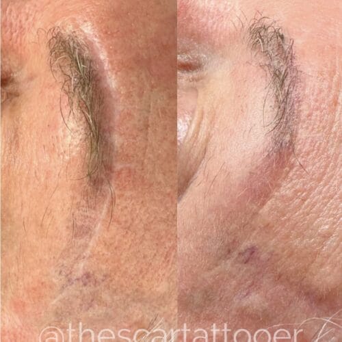 Scar camouflage tattoo by Shonna at DAELA Cosmetic Tattoo