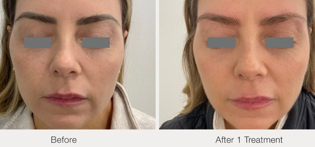 before after brow tattoo removal 1 treatment