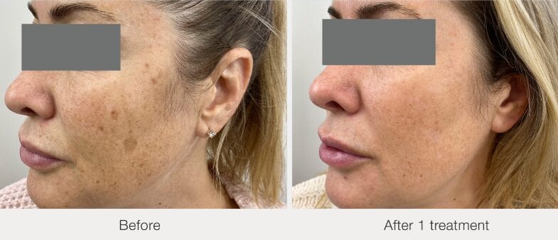 before after picoway laser face treatment portland oregon