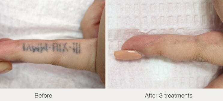 PicoWay laser tattoo removal after 3 sessions