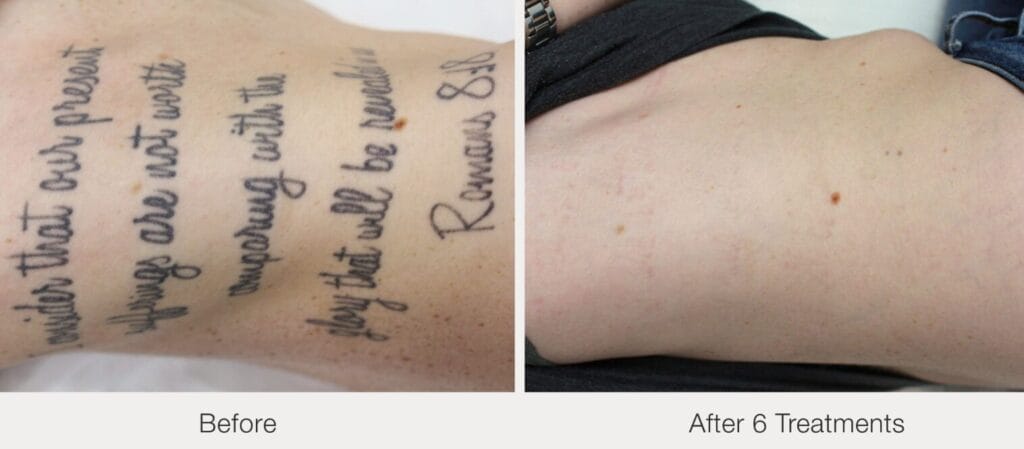 PicoWay laser tattoo removal 6 sessions