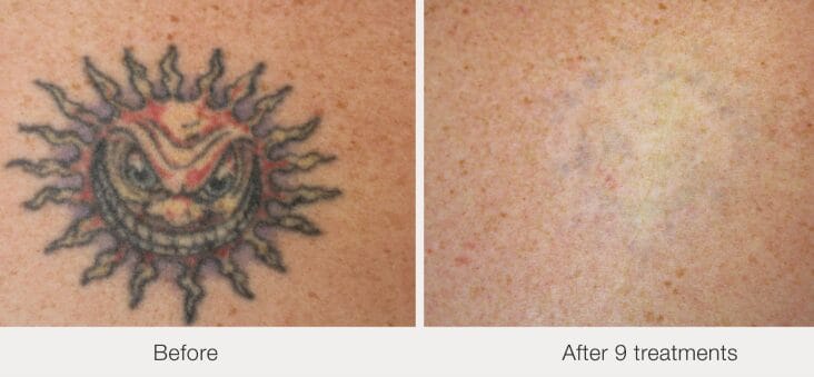 PicoWay laser tattoo removal after 9 treatments