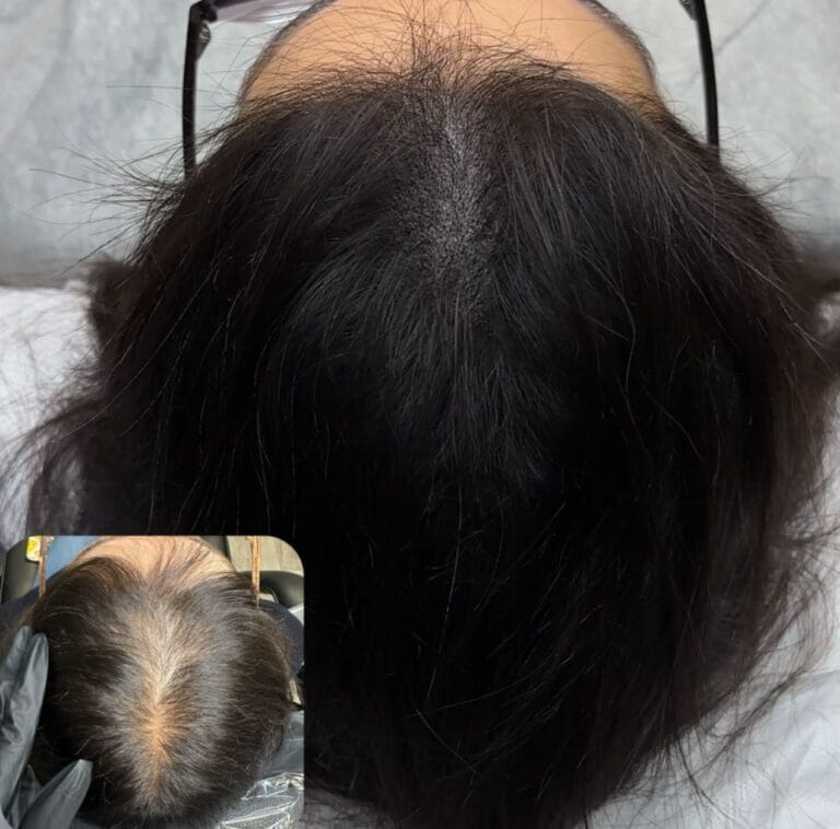 Scalp Micropigmentation Density for Women at DAELA Cosmetic Tattoo
