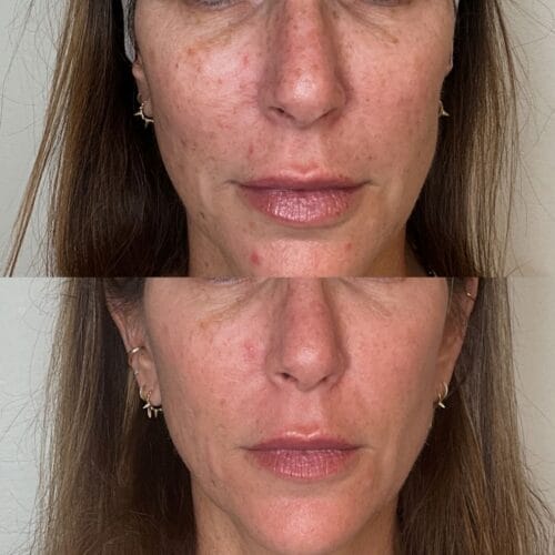 Laser Facial Portland at DAELA