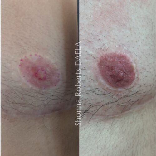 Areola Restoration Tattoo at DAELA by Shonna